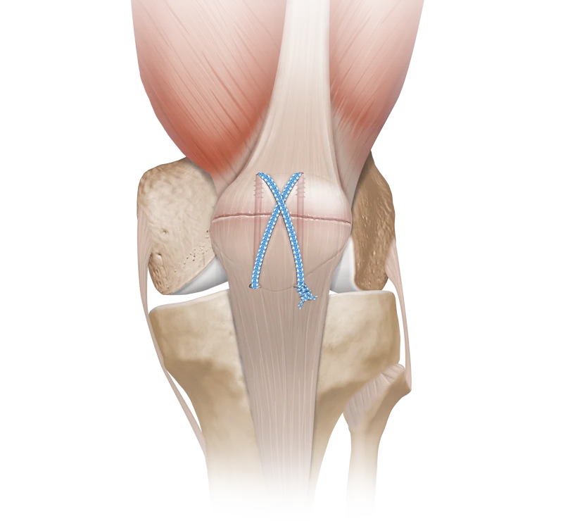 knee_fracture_management_devices