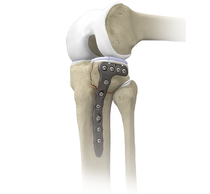 knee_fracture_plates_and_screws